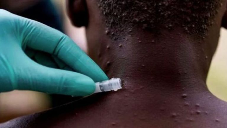 REPORTAN 5 CASOS DE LA VIRUELA DEL MONO EN LA ARGENTINA